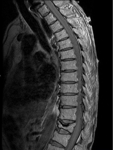 Figure 1: This MRI image shows post-kyphoplasty changes at T12 with no evidence of acute complications and a stable mild chronic compression fracture of the L1 superior endplate. 