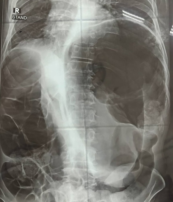 Abdominal plain X-ray showing an omega sign